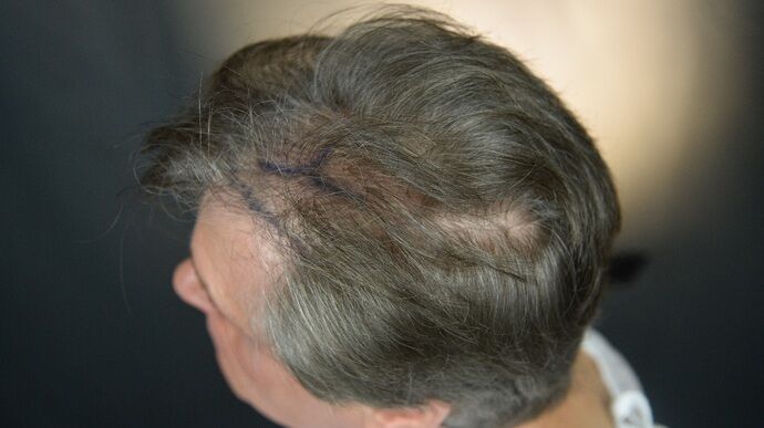 FUT Hair Restoration: Case 46 - Before