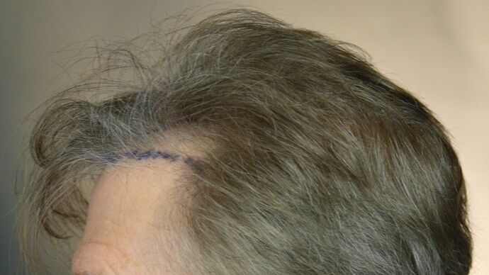 FUT Hair Restoration: Case 46 - Before