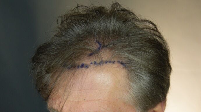 FUT Hair Restoration: Case 46 - Before