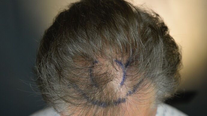 FUT Hair Restoration: Case 46 - Before