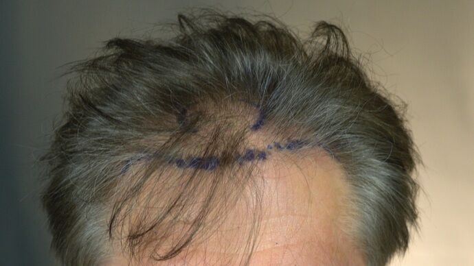 FUT Hair Restoration Case 46 - Before