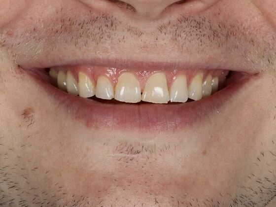Porcelain Veneers: Tim - Before