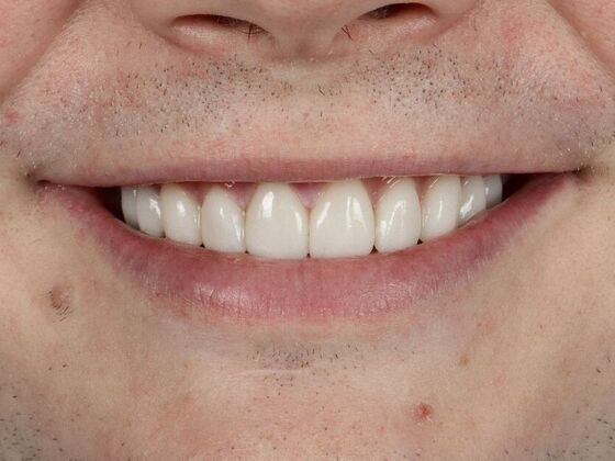 Porcelain Veneers: Tim - After
