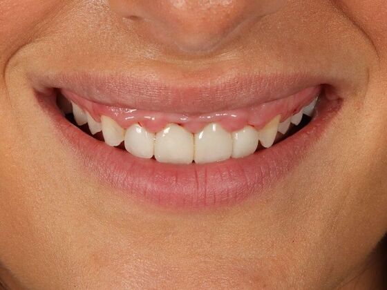 Porcelain Veneers: Kara - Before