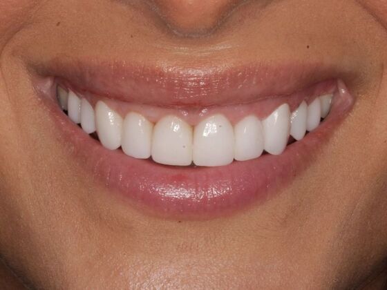 Porcelain Veneers: Kara - After