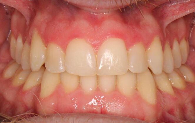 Orthodontics : Caleb  - Invisalign - After