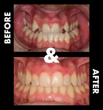 Orthodontics  Caleb  - Invisalign  - Before