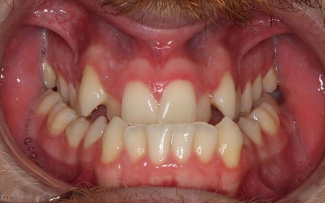 Orthodontics : Caleb  - Invisalign - Before