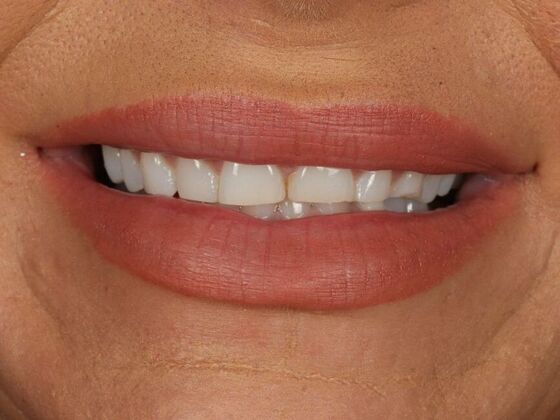 Full Mouth Rehabilitation: Kinslie - Before