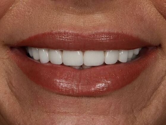 Full Mouth Rehabilitation: Kinslie - After