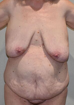 Massive Weight Loss : Case 160 - Before