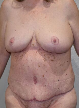 Massive Weight Loss : Case 160 - After