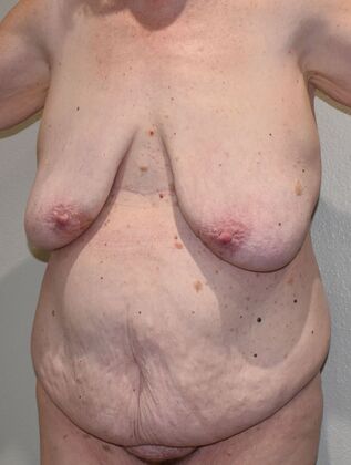 Mommy Makeover: Case 323 - Before