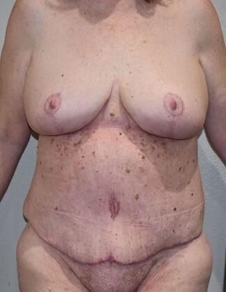 Mommy Makeover Case 323 - After