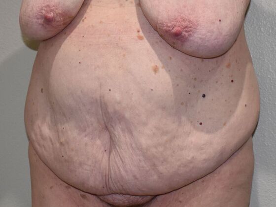 Tummy Tuck (Abdominoplasty): Case 509 - Before