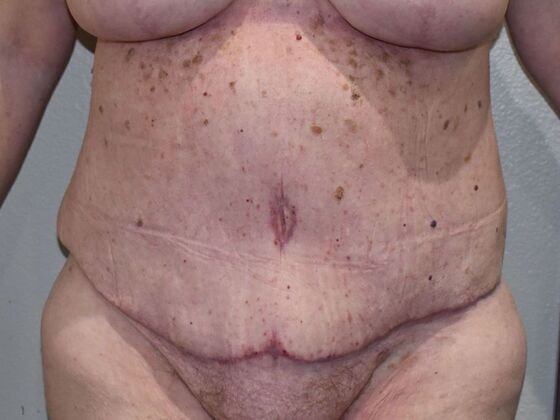 Tummy Tuck (Abdominoplasty): Case 509 - After