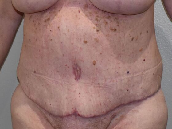 Tummy Tuck (Abdominoplasty): Case 509 - After