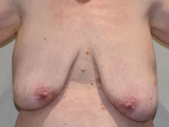 Breast Lift (Mastopexy) Case 228 - Before