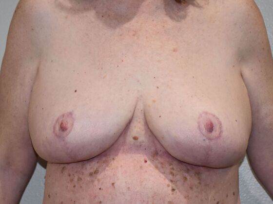 Breast Lift (Mastopexy) Case 228 - After