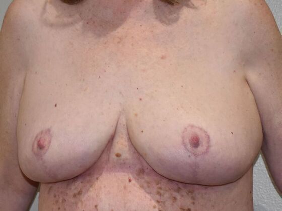 Breast Lift (Mastopexy): Case 228 - After