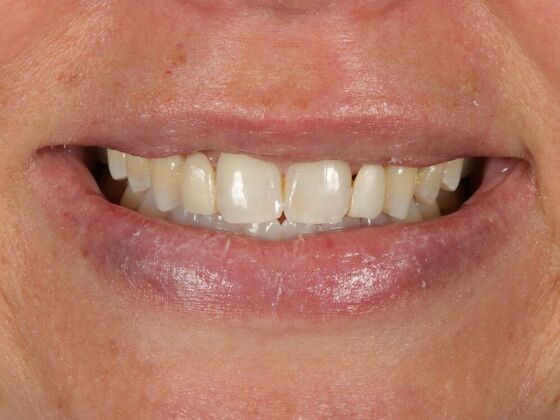 Porcelain Veneers: Alex - Before