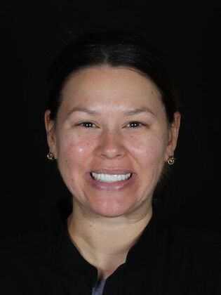 Porcelain Veneers: Alex - After