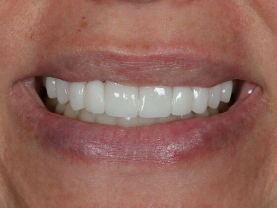 Porcelain Veneers: Alex - After