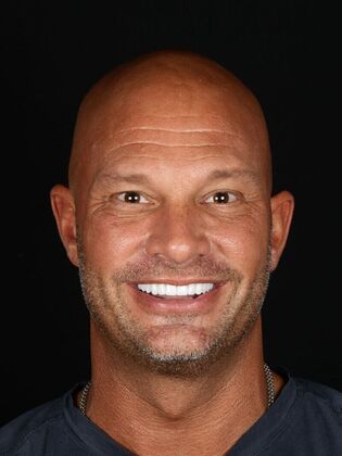 Porcelain Veneers: Kevin - After