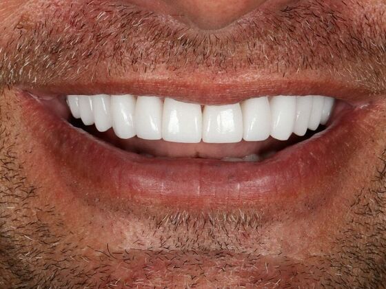 Porcelain Veneers: Kevin - After