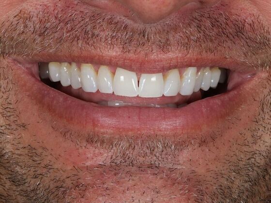 Porcelain Veneers: Kevin - Before