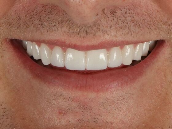 Full Mouth Rehabilitation: Justin - After