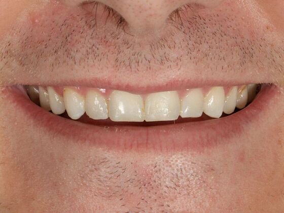 Full Mouth Rehabilitation: Justin - Before