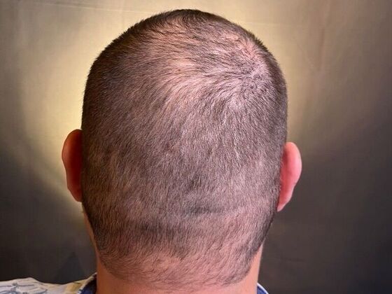 FUT Hair Restoration: Case 47 - Before