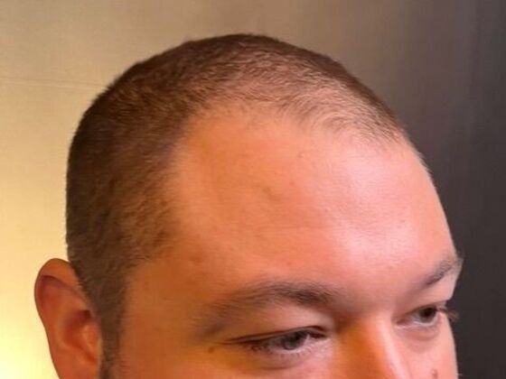 FUT Hair Restoration: Case 47 - Before