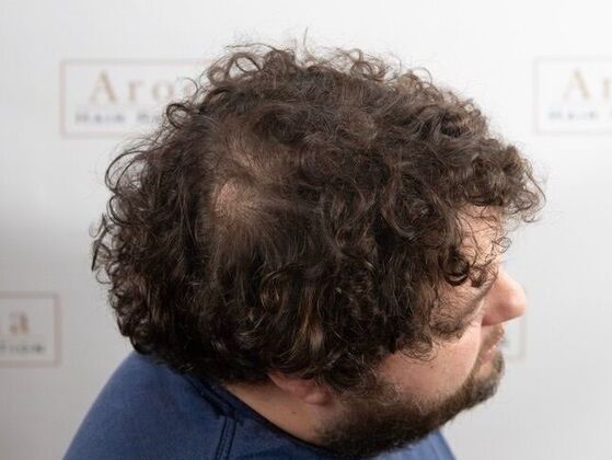 FUT Hair Restoration: Case 47 - After