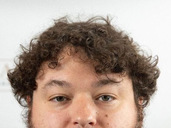 FUT Hair Restoration Case 47 - After