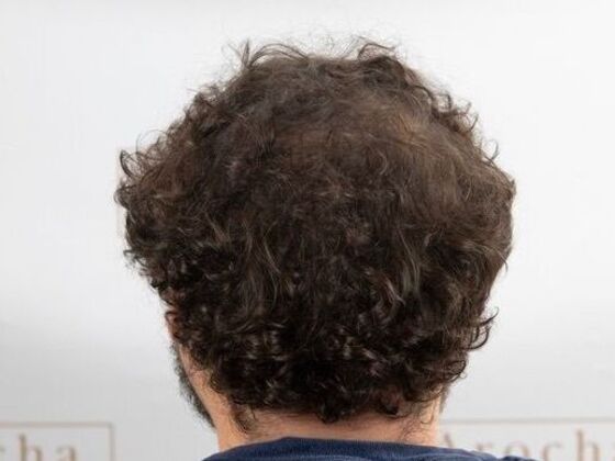 FUT Hair Restoration: Case 47 - After