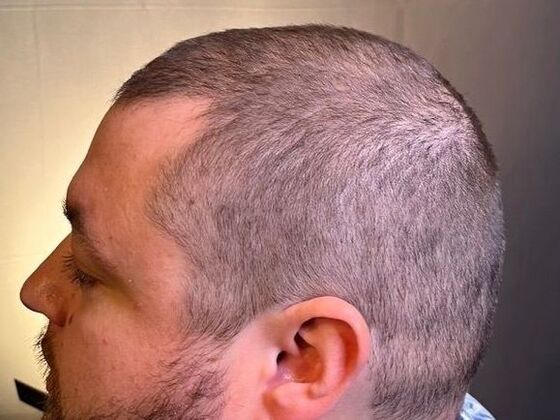 FUT Hair Restoration: Case 47 - Before