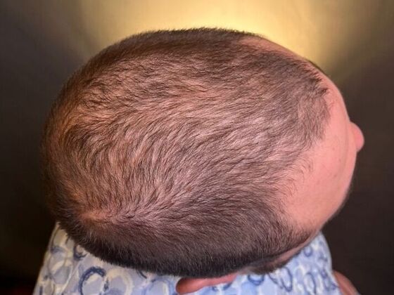 FUT Hair Restoration: Case 47 - Before