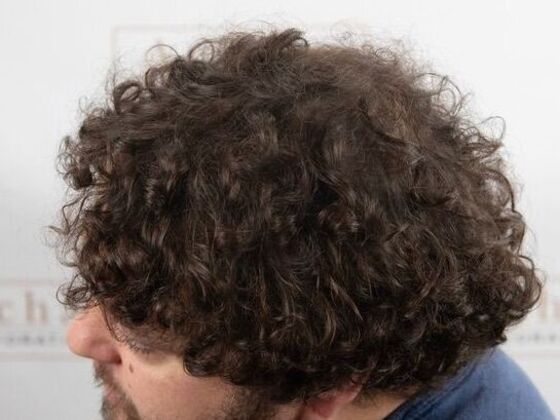 FUT Hair Restoration: Case 47 - After