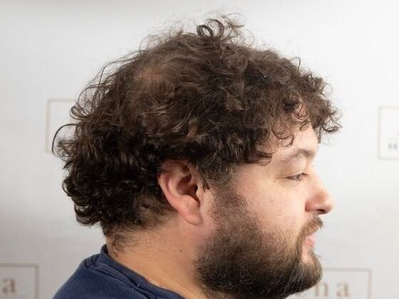 FUT Hair Restoration: Case 47 - Before