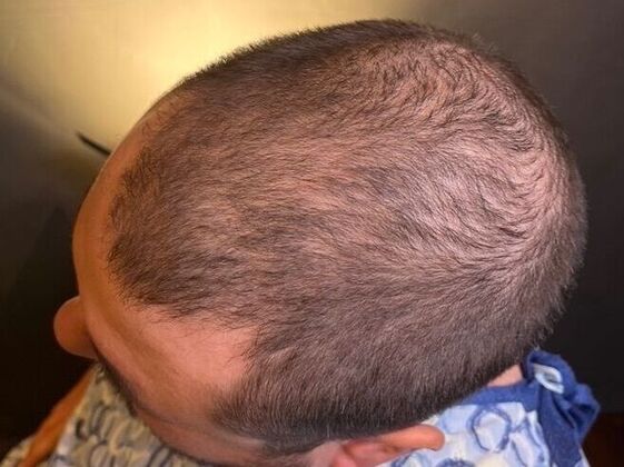 FUT Hair Restoration: Case 47 - Before