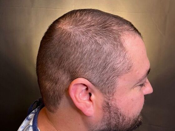 FUT Hair Restoration: Case 47 - After