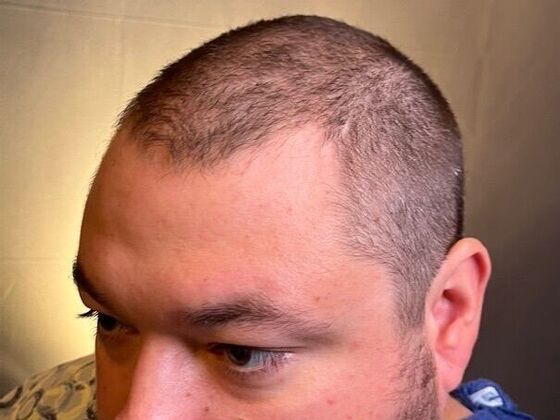 FUT Hair Restoration: Case 47 - Before