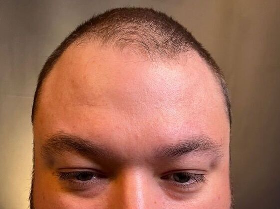 FUT Hair Restoration Case 47 - Before