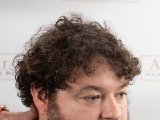 FUT Hair Restoration: Case 47 - After