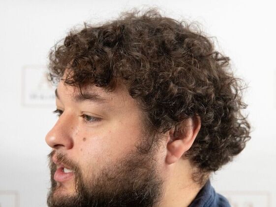 FUT Hair Restoration: Case 47 - After