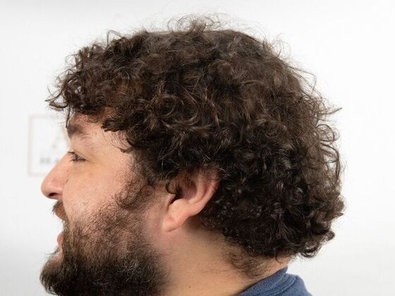 FUT Hair Restoration: Case 47 - After