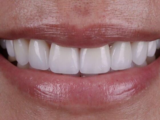Smile Makeover & Veneers: Tina - After