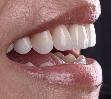 Smile Makeover & Veneers Tina